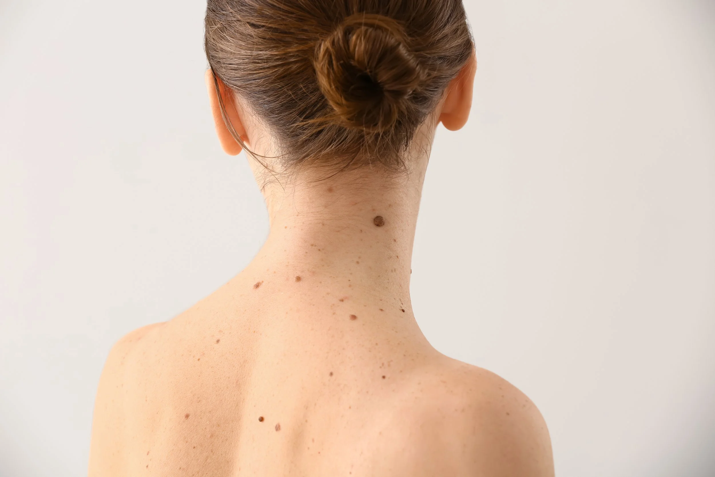 Woman's back and neck with moles