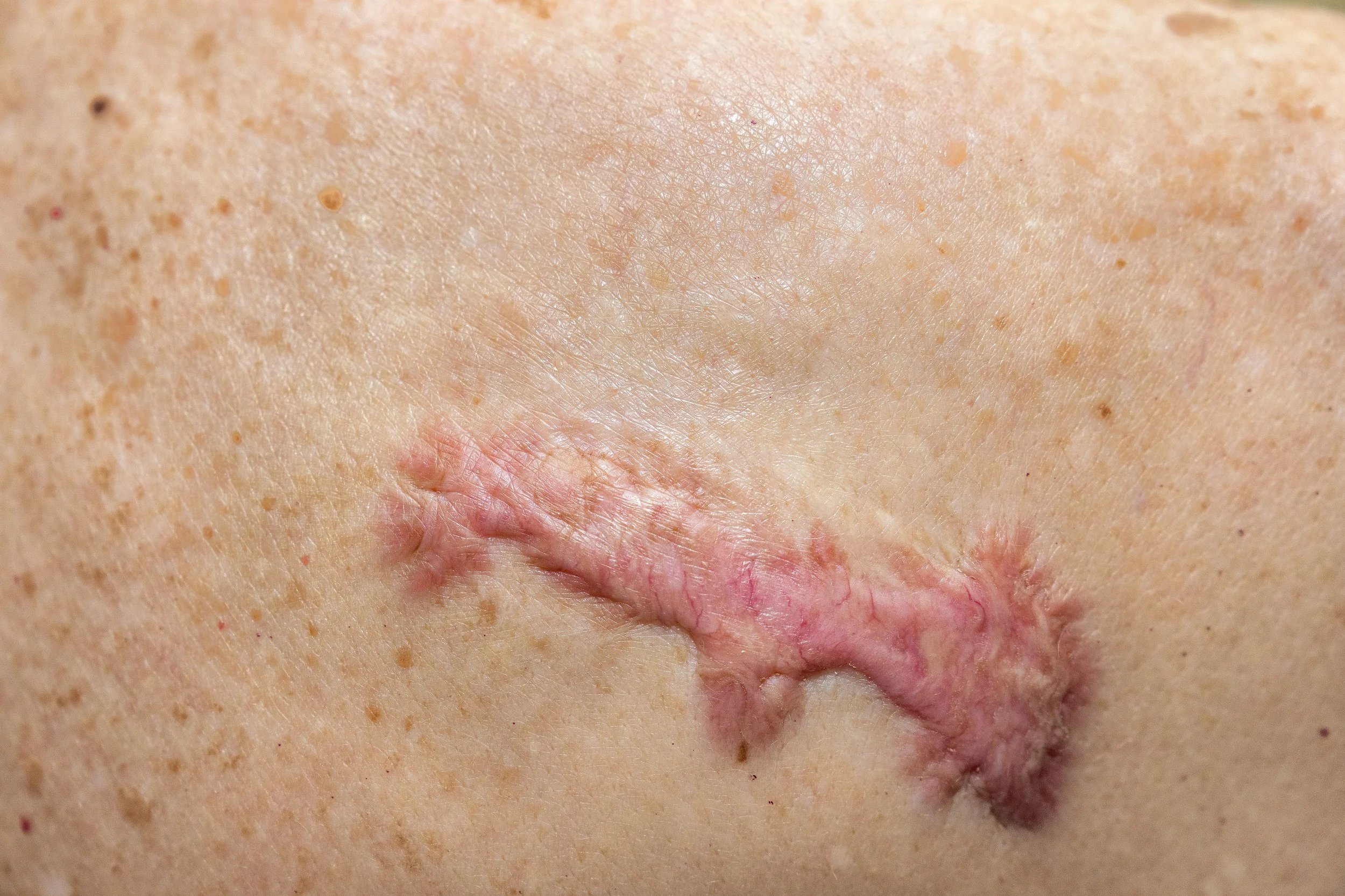 Close up of a keloid scar