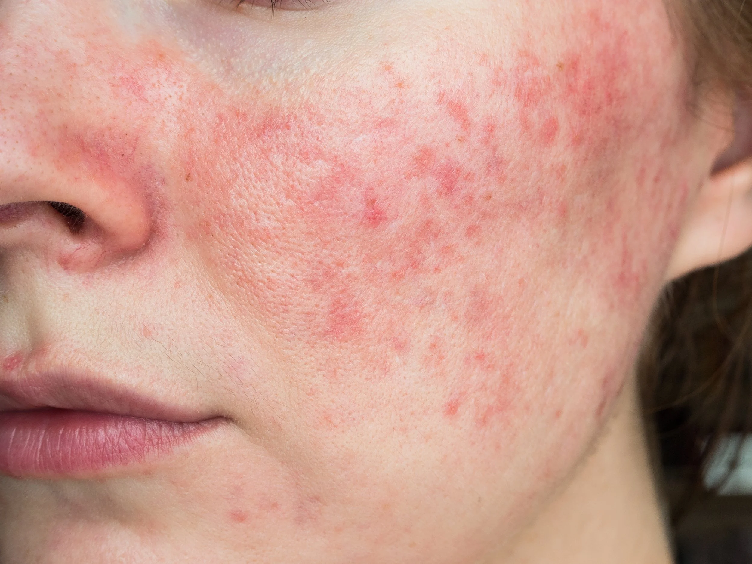 Rosacea on the cheeks of a woman