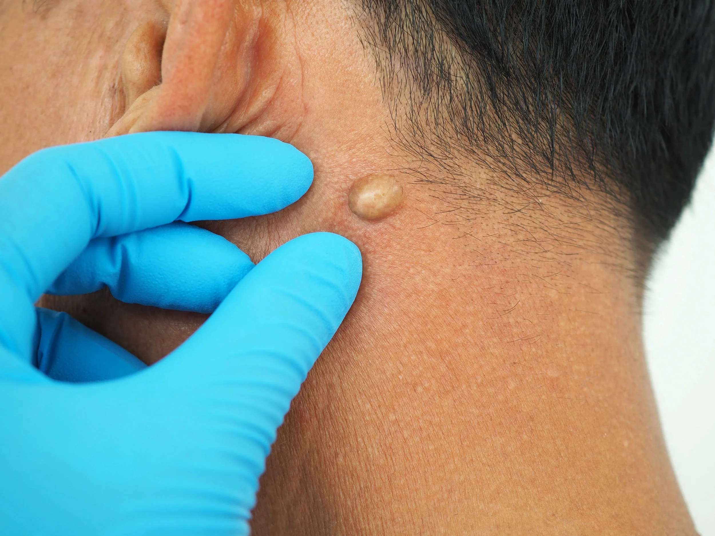 Cyst or lipoma on the neck of a male patient