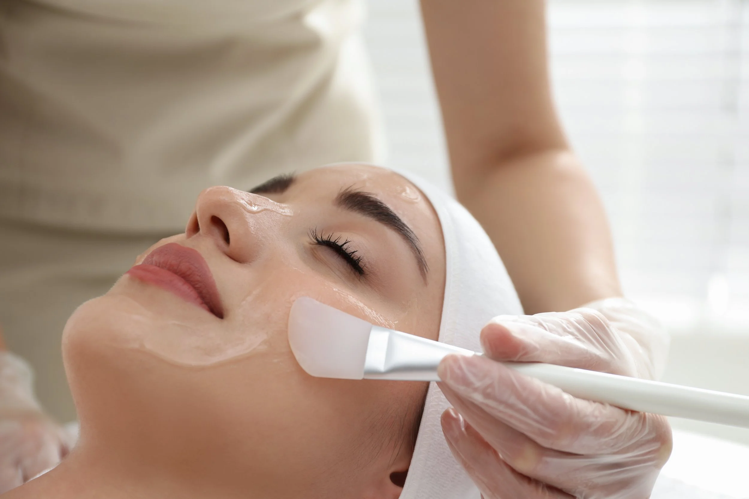 Female receiving a chemical peel
