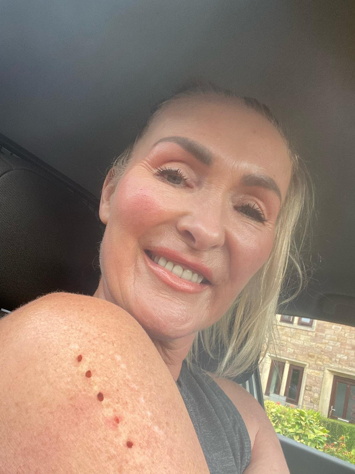 A woman smiling in a car, showing a shoulder with small red marks or scars on her skin.