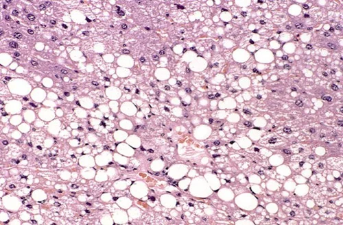 Barking Up the Wrong Tree - MASH & Fatty Liver Disease