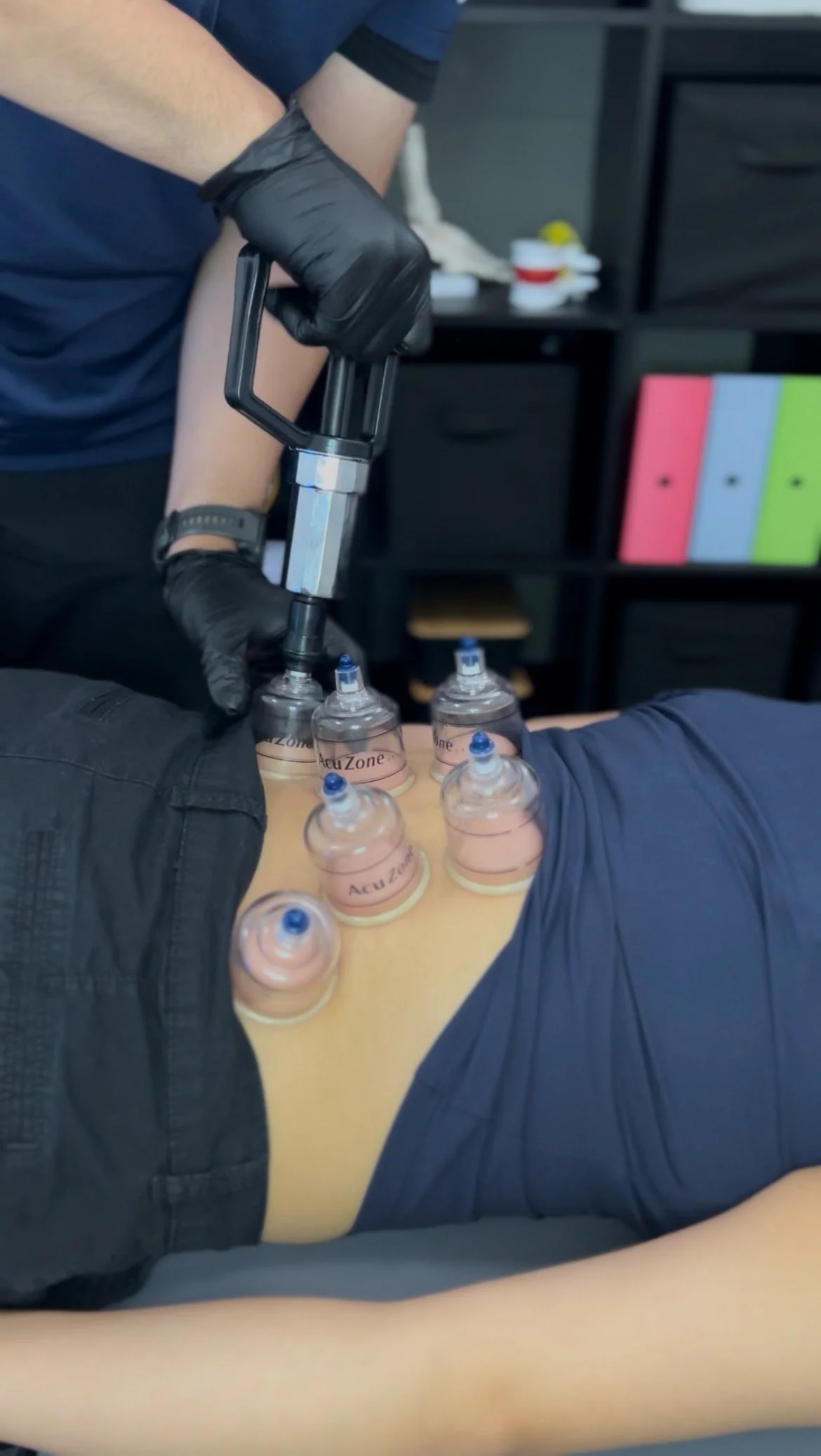 A person receiving cupping therapy with multiple suction cups on their back. The practitioner is using a pump to create suction in the cups. Located in encino ca.