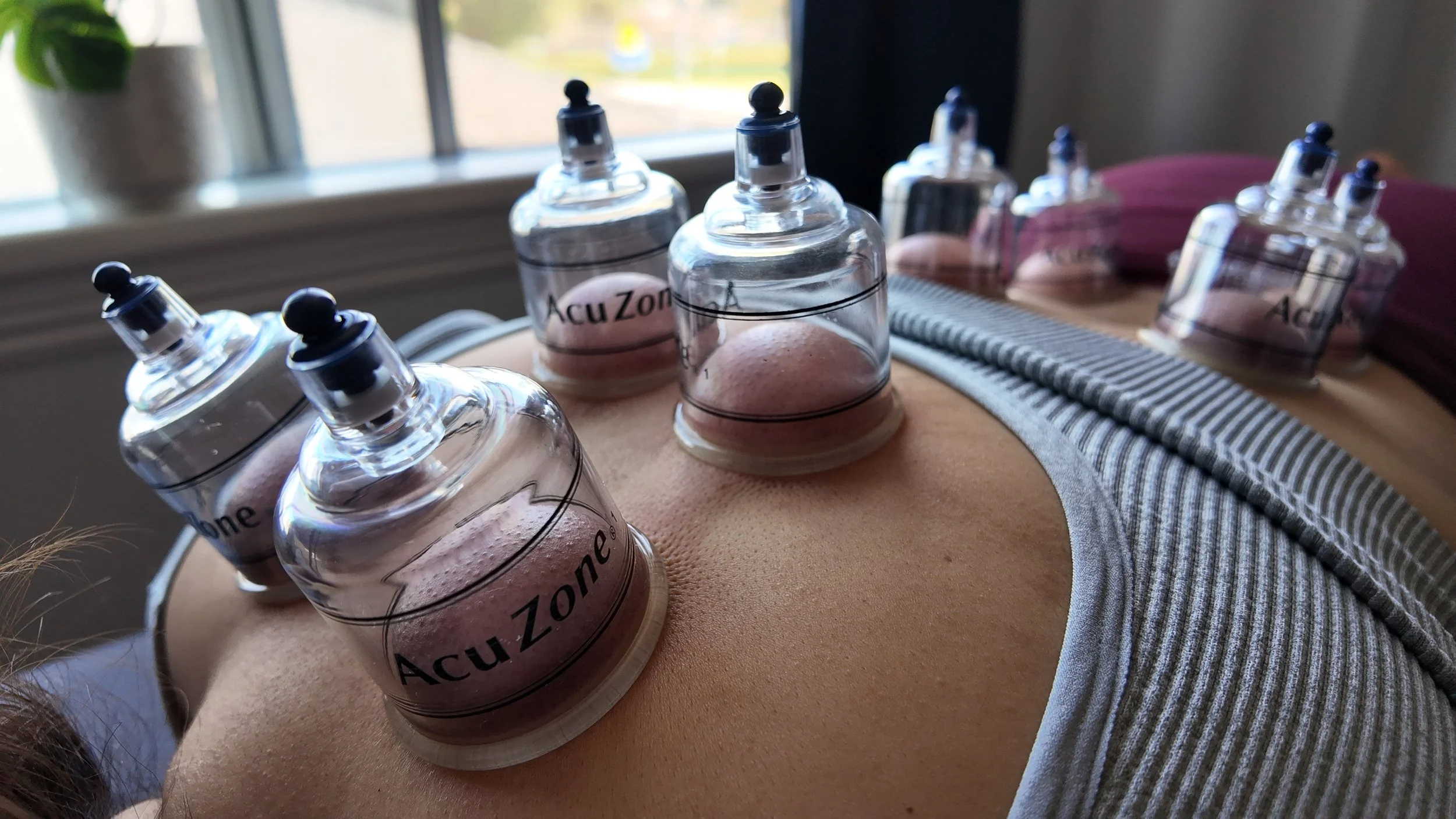 Cupping