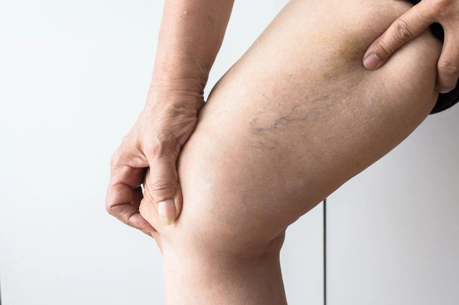 Close-up of a person pinching their thigh, showing visible varicose veins.