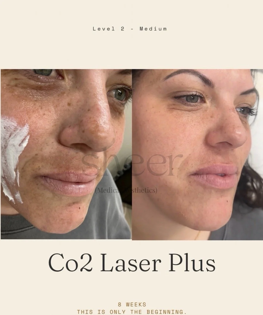Before and after images of a woman's face showing skin improvement following Co2 Laser Plus treatment, 8 weeks apart.