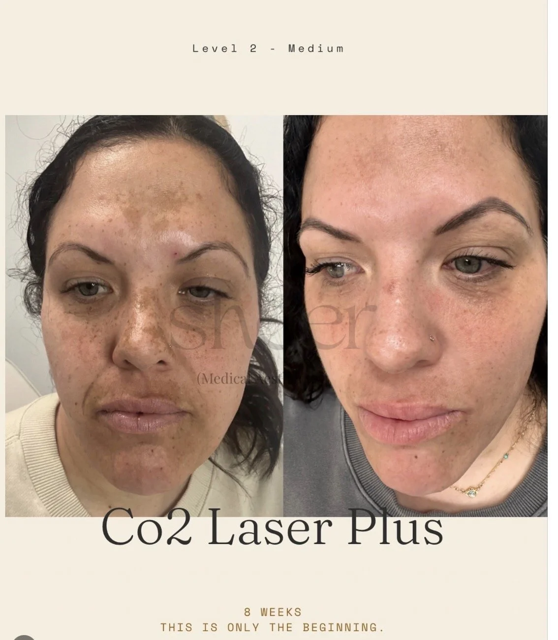 Before and after photos of a woman's face showing improvements in skin clarity and pigmentation after 8 weeks of Co2 Laser Plus treatment.
