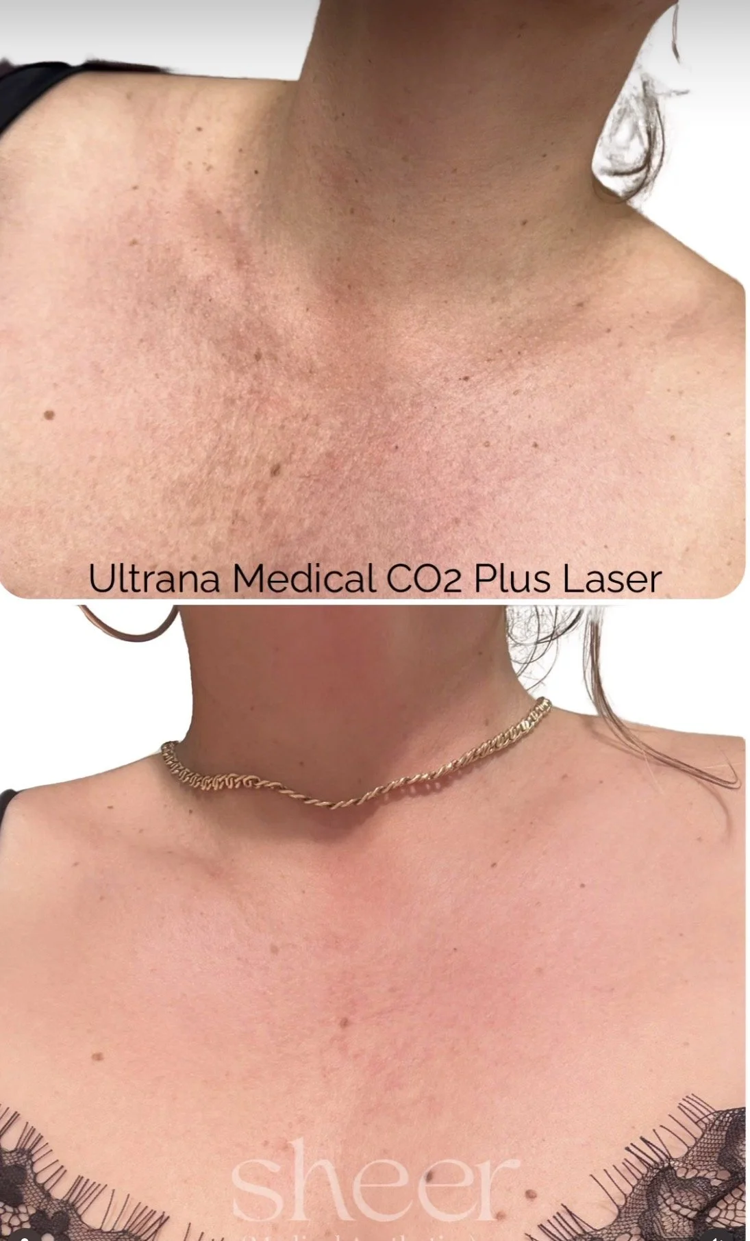 Before and after images showing the results of Ultrana Medical CO2 Plus Laser treatment on a person's neck and chest area, with improvements in skin texture and pigmentation.