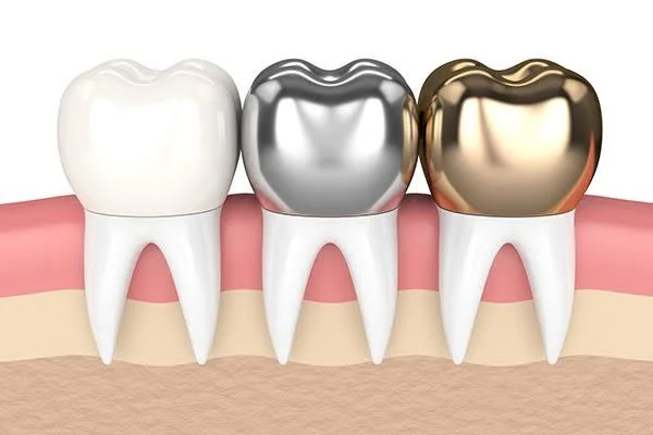 Dentist explaining a porcelain dental crown treatment to a patient in Irvine