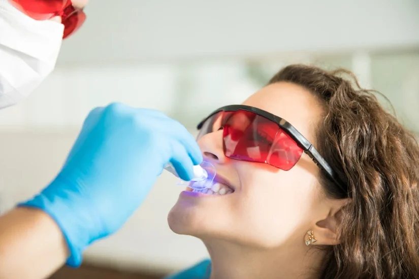 Professional teeth whitening