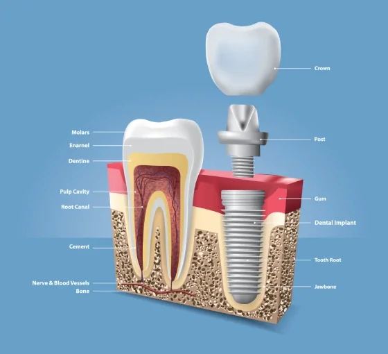Dental implant model showing implant and crown