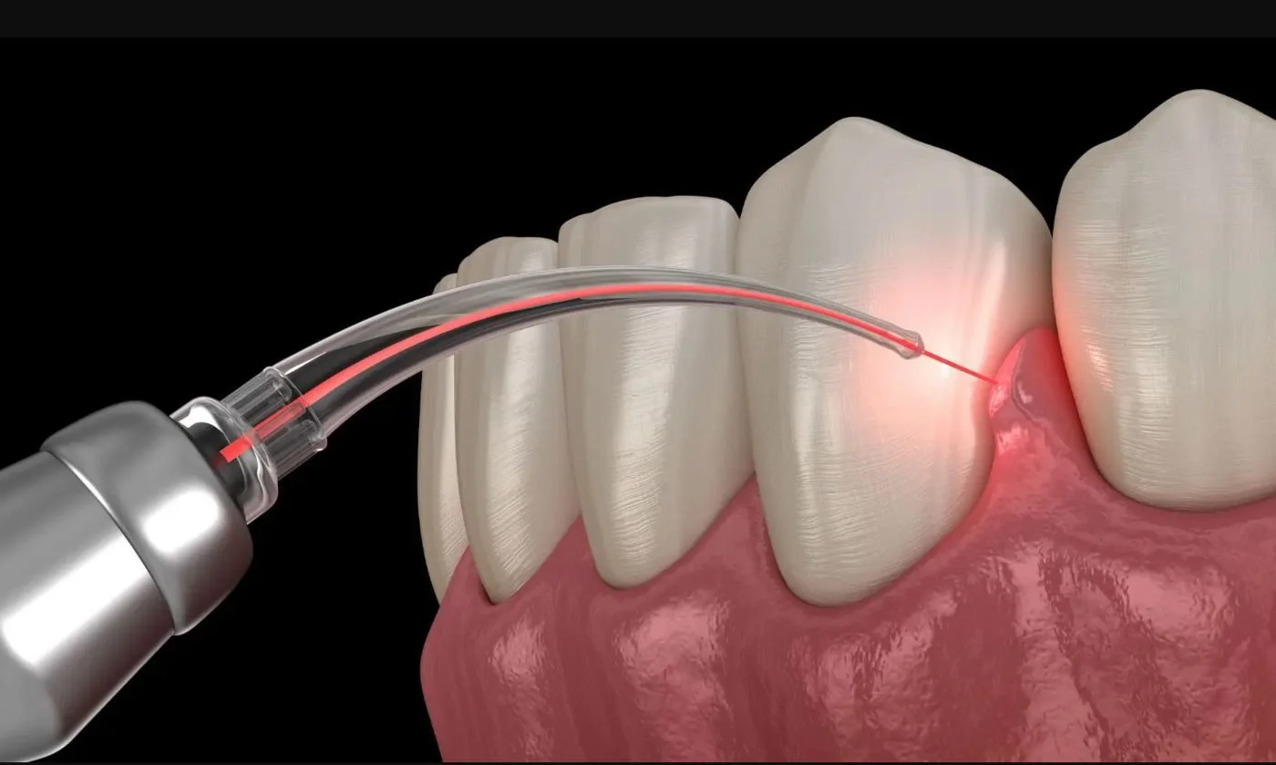 Dental laser treating gums - laser dentistry in Irvine at Sand Canyon Dental