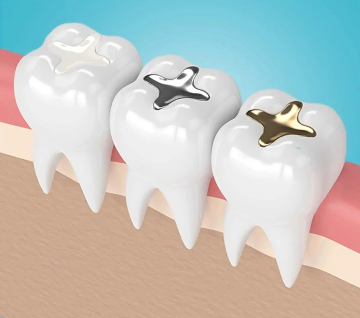 Illustration of molars with metal fillings that can be replaced with tooth-colored fillings in Irvine at Sand Canyon Dental