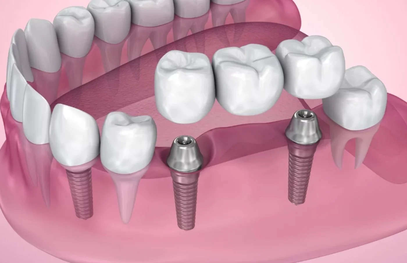 3D illustration of an implant-supported fixed dental bridge - fixed dental bridges in Irvine