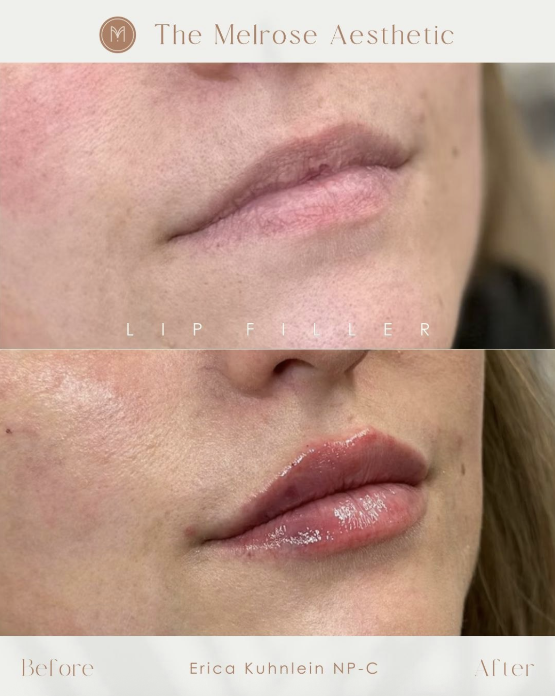 Comparison of lips showing before and after lip filler treatment. The top image shows natural lips; the bottom image shows lips with added volume and glossy finish.
