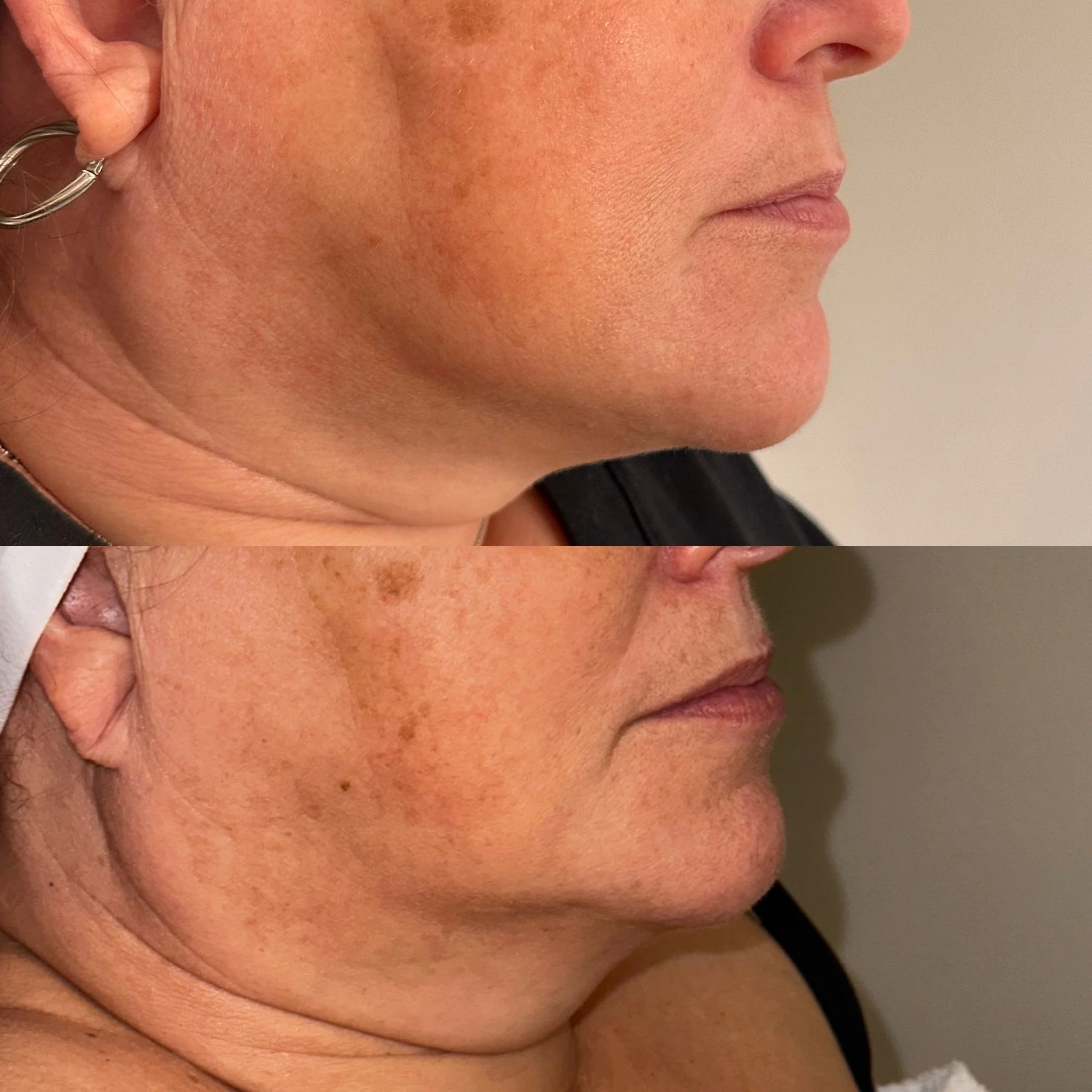 Side-by-side comparison of a woman's face showing skin improvement; top photo shows smoother skin, bottom photo shows darker spots and uneven skin tone.