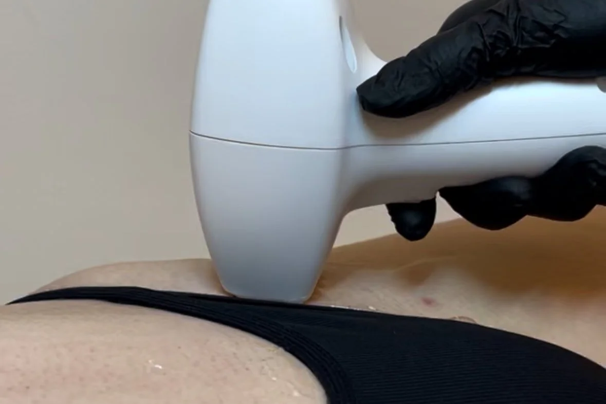 A person wearing black gloves holding a medical or cosmetic device placed on their lower abdomen or pelvic area, with the device emitting a glow.