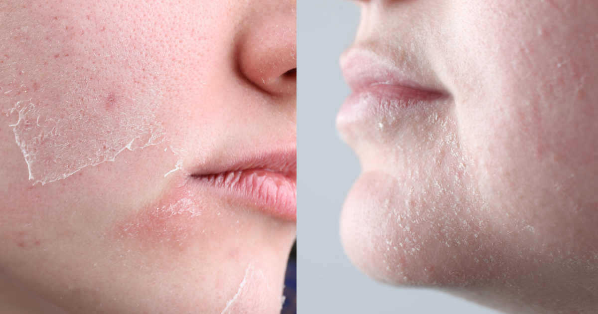 What are the signs of a damaged skin barrier?