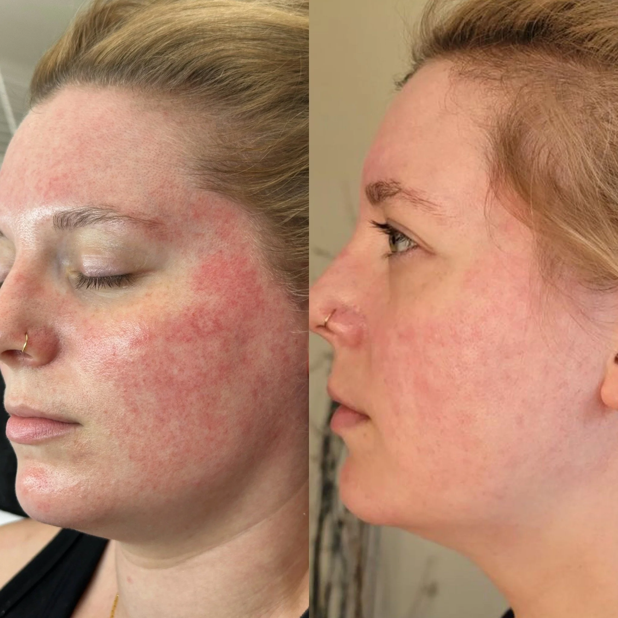 Side-by-side comparison of a woman's face showing before and after skin treatment, with visible reduction in redness and skin irritation.