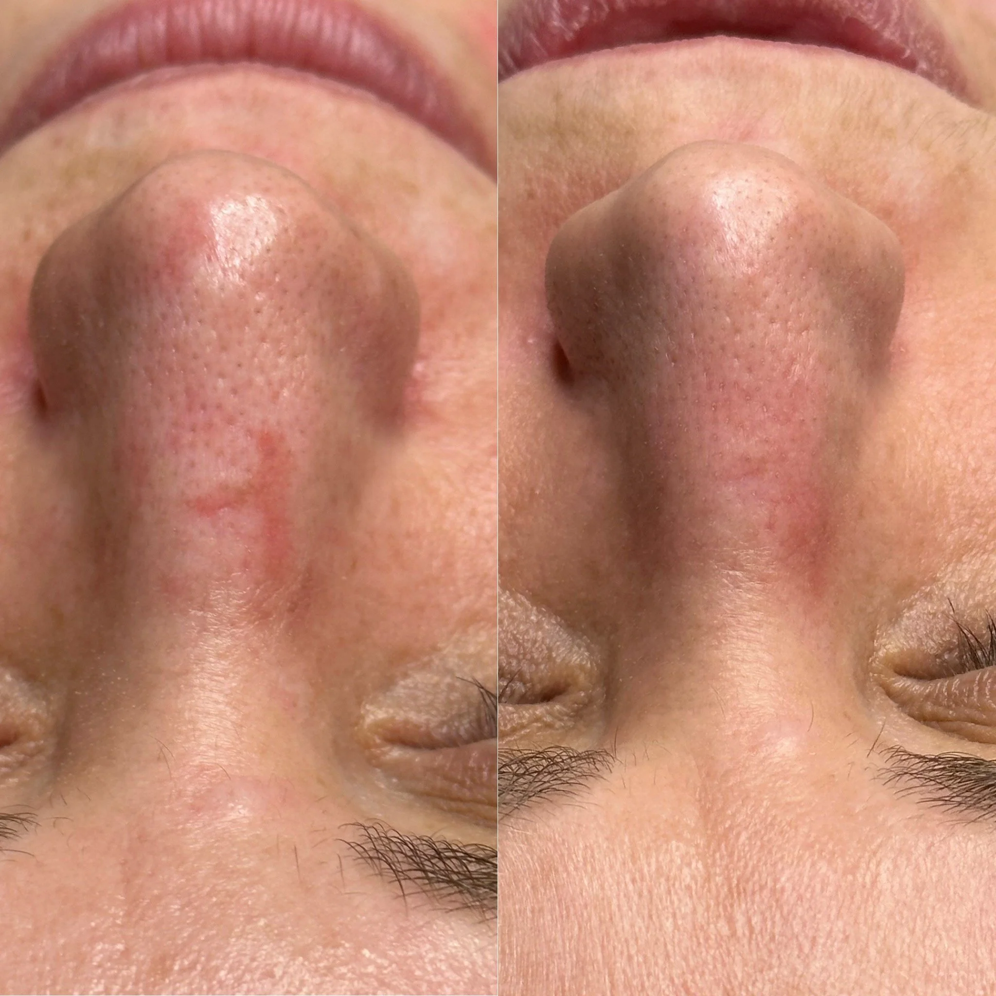 Close-up of a person's nose from below, showing before and after skin treatment with enlarged pores and smoother skin, with a difference in pore size and skin texture.