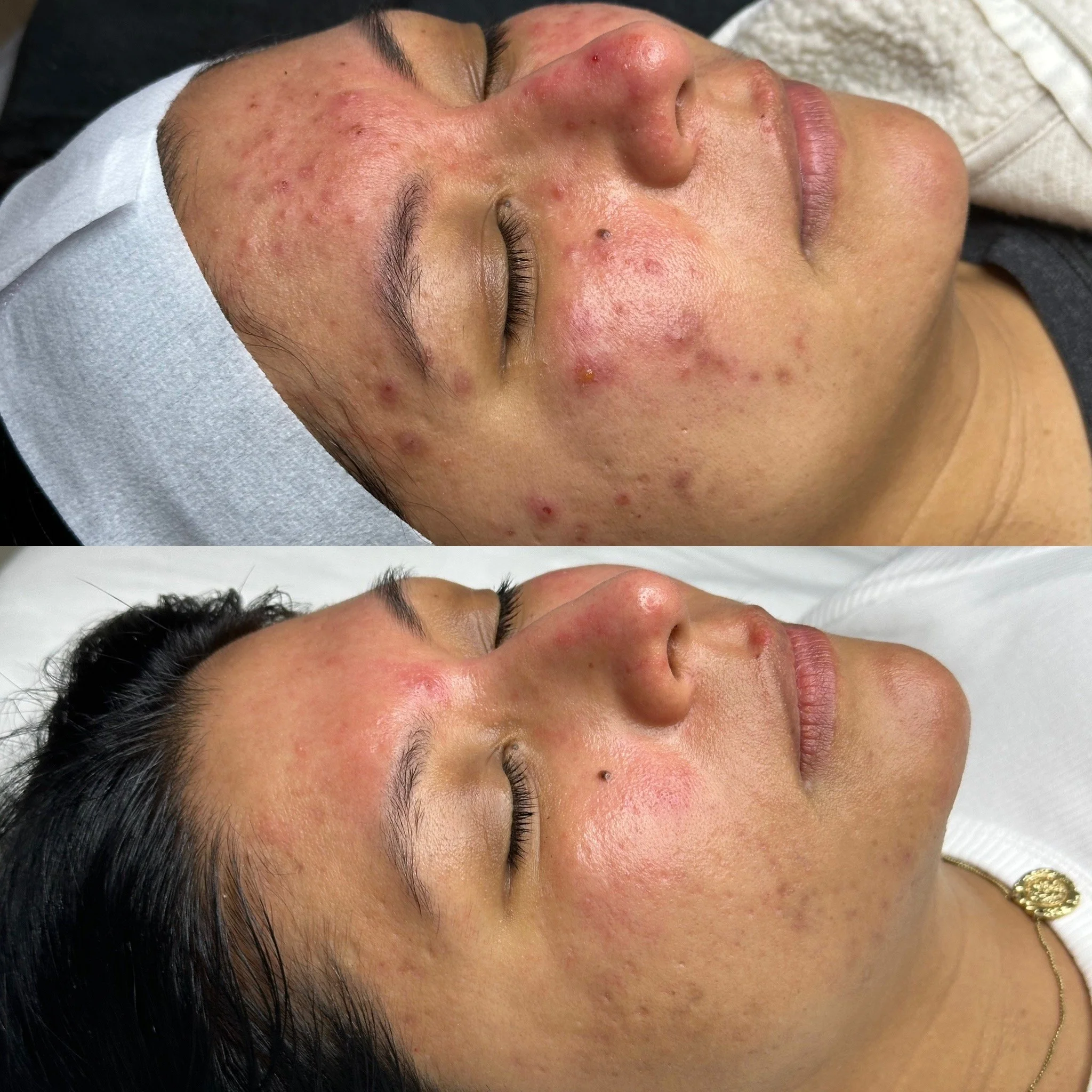 Comparison of a woman's face before and after acne treatment, showing significant reduction in acne and skin redness.