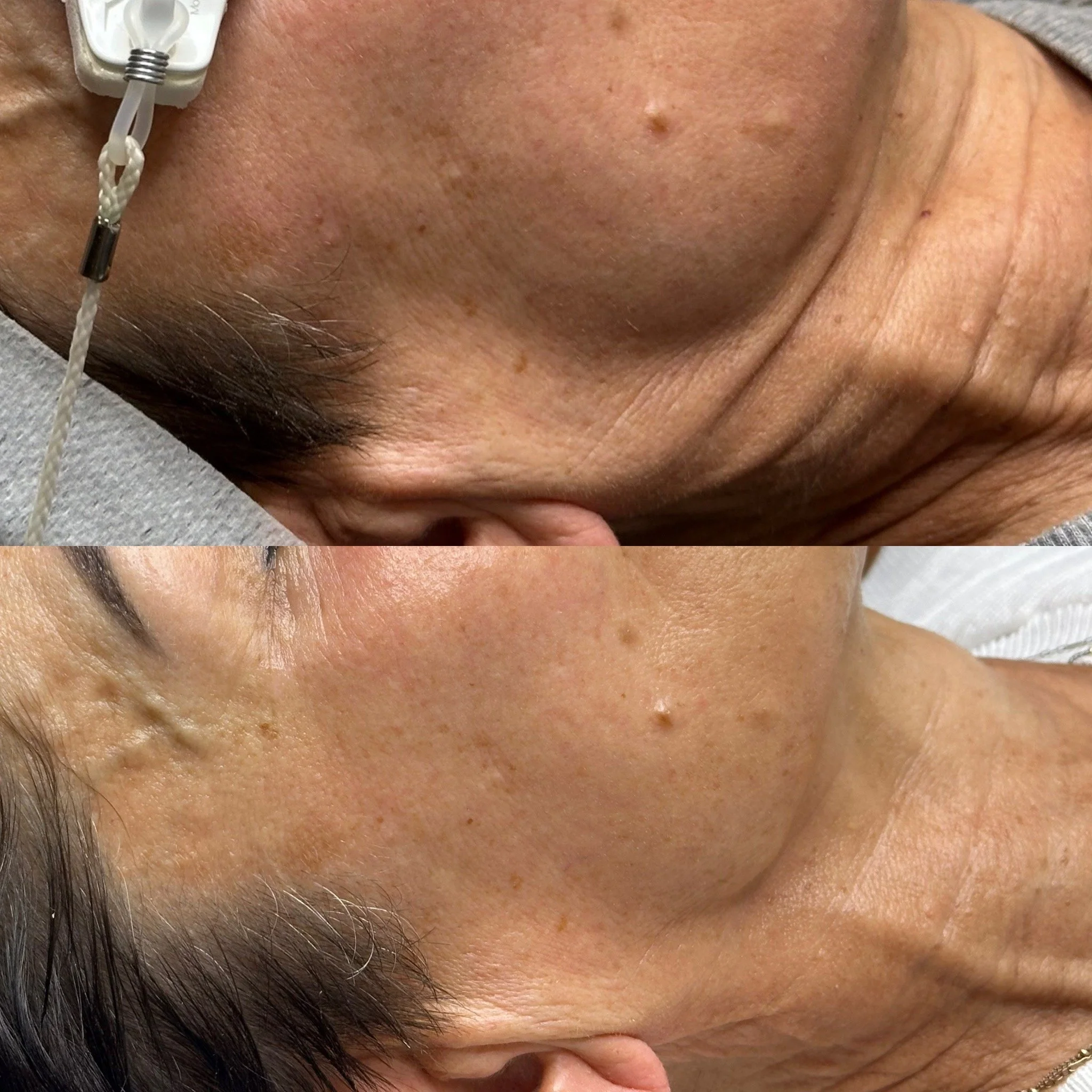 Comparison of a person's forehead before and after skincare treatment, showing reduced wrinkles and improved skin texture.
