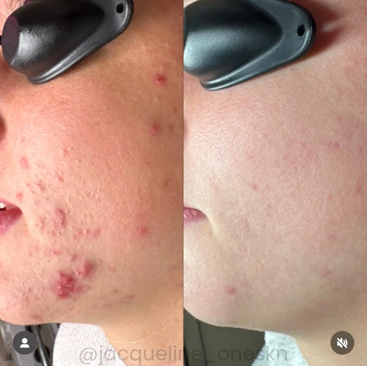 Comparison of a person's face showing skin with acne and redness on the left side, and clear, smooth skin on the right side.