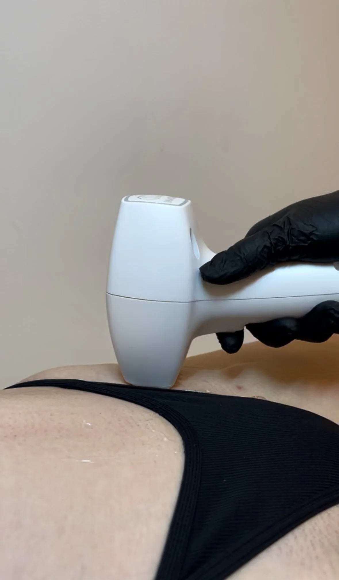 A person receiving a medical or cosmetic treatment with a handheld device on their abdomen, wearing black clothing, with gloved hand holding the device.