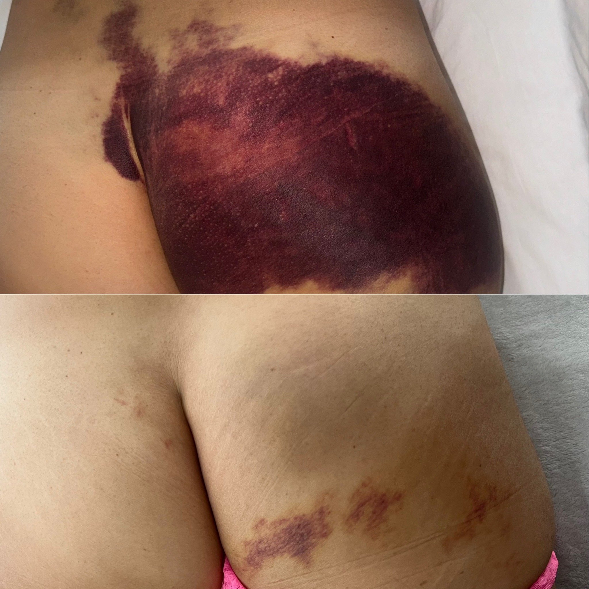 Comparison of two skin injuries: the top shows a large, darkened, and crusted bruise or burn on the shoulder; the bottom shows a healed bruise or burn with scabbing and discoloration on the shoulder and side of the chest.