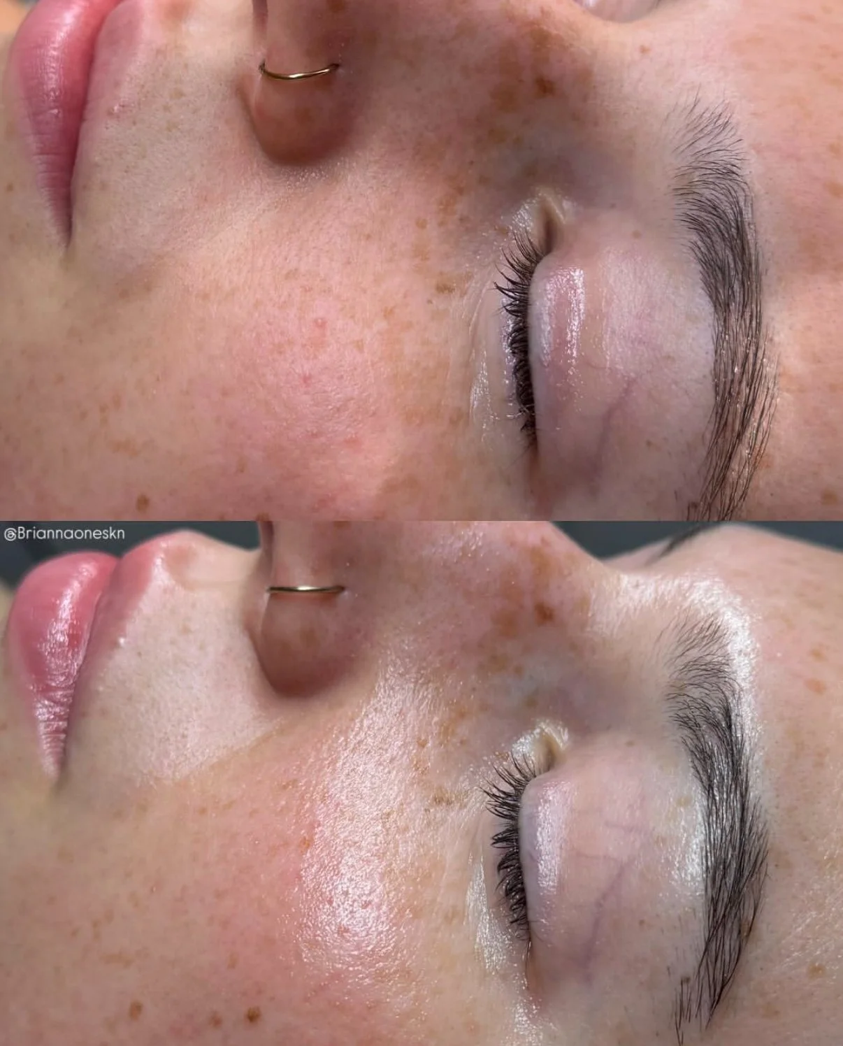 Close-up of a woman's face before and after skincare treatment, focusing on the cheek, nose, and eye area, showing improved skin texture and clarity.
