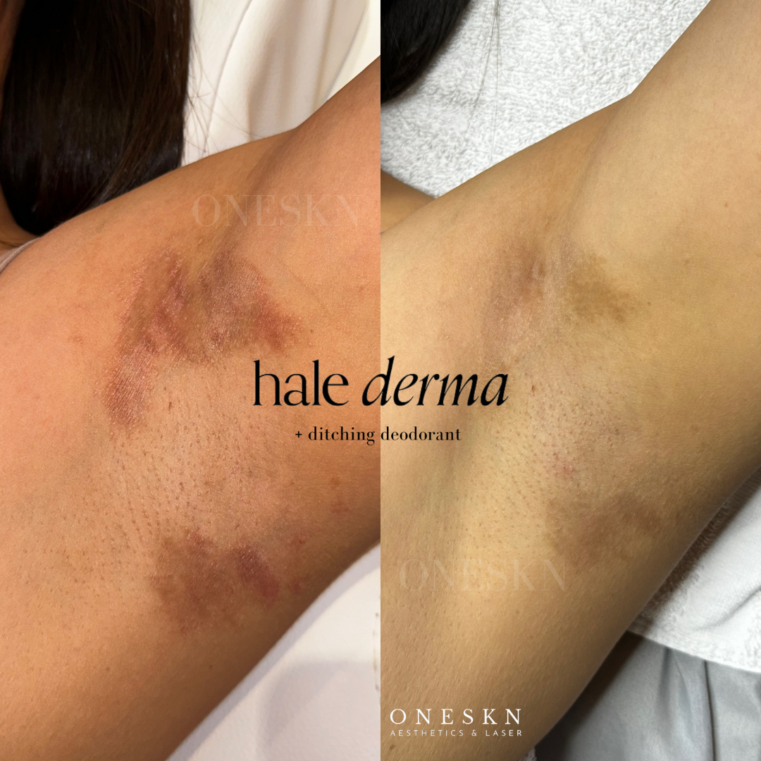 A side-by-side comparison of armpits showing skin conditions before and after treatment for dermatitis, with the text 'hale derma' and 'ditchling deodorant' in the center.