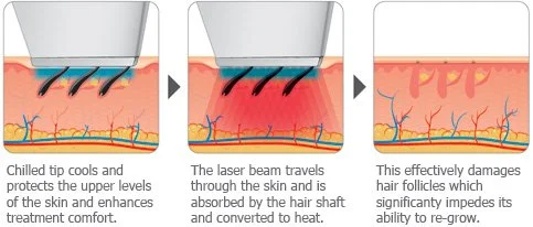 Diagram demonstrating laser hair removal process, showing laser beam cooling skin, traveling through skin to damage hair follicles, which impairs their ability to regrow.