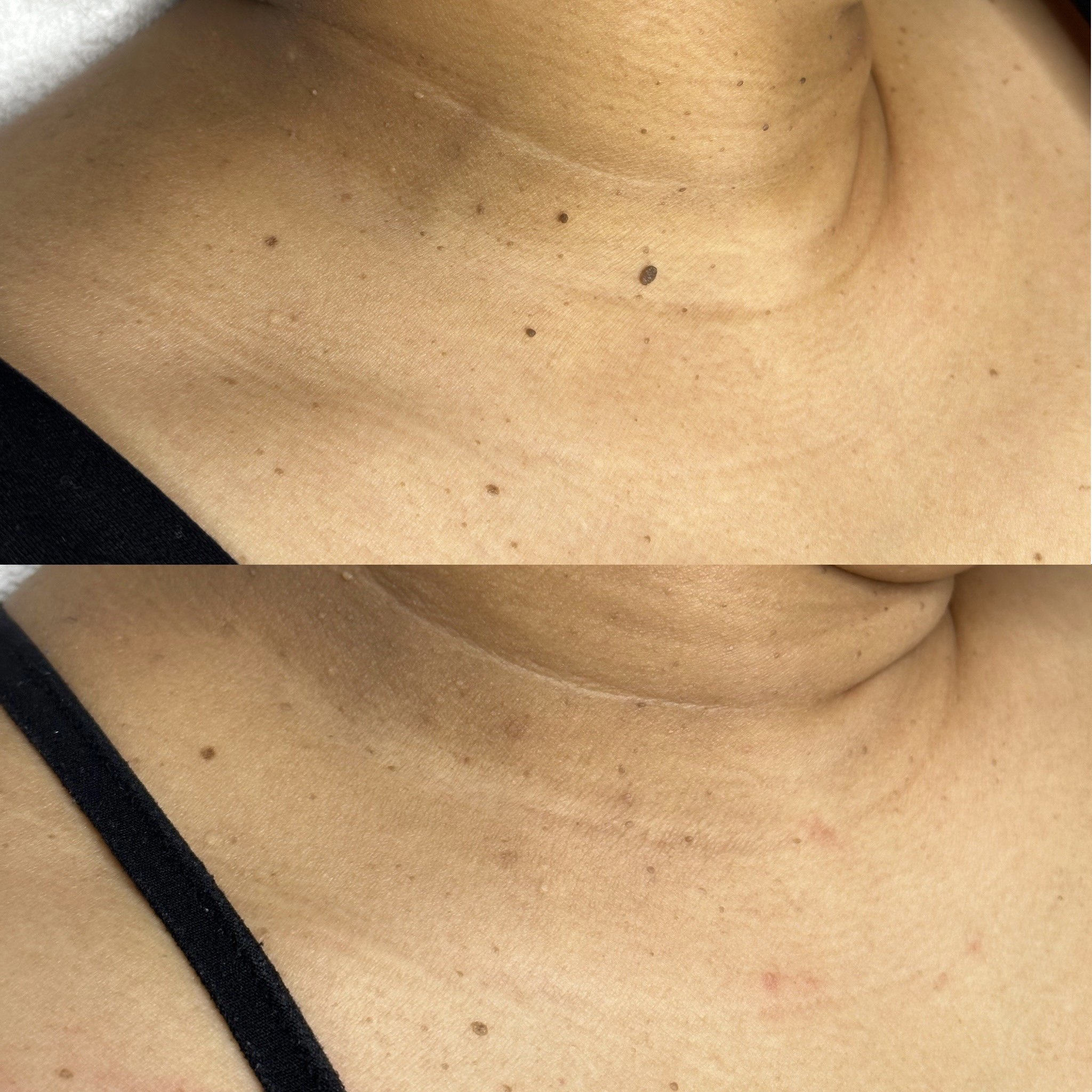 A close-up of a person's neck and collarbone area showing skin with moles before and after a skin treatment.