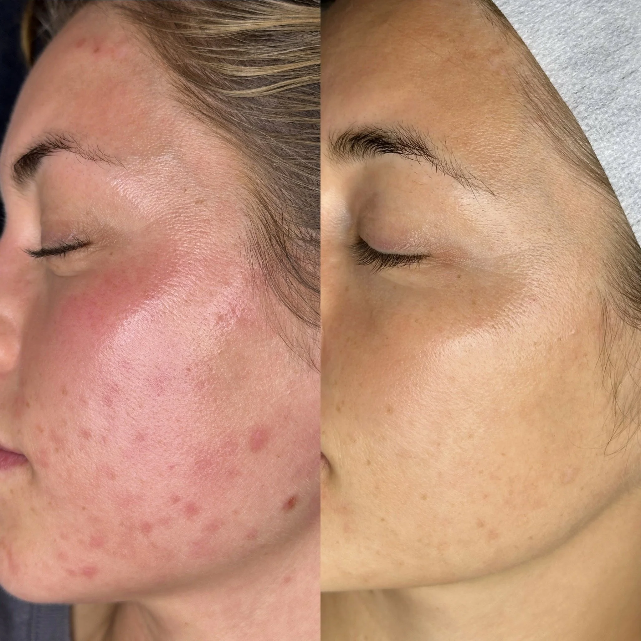 Side-by-side comparison of a person's face showing skin improvement; left side with redness and acne, right side with clearer, smoother skin.