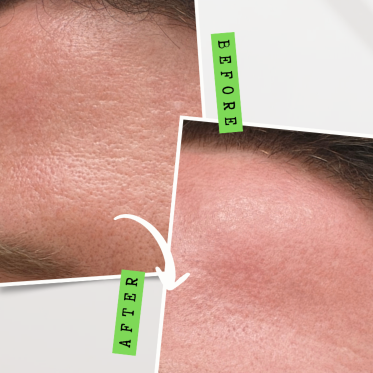 Close-up comparison of skin before and after a skincare treatment, showing reduced pore size and smoother skin texture.