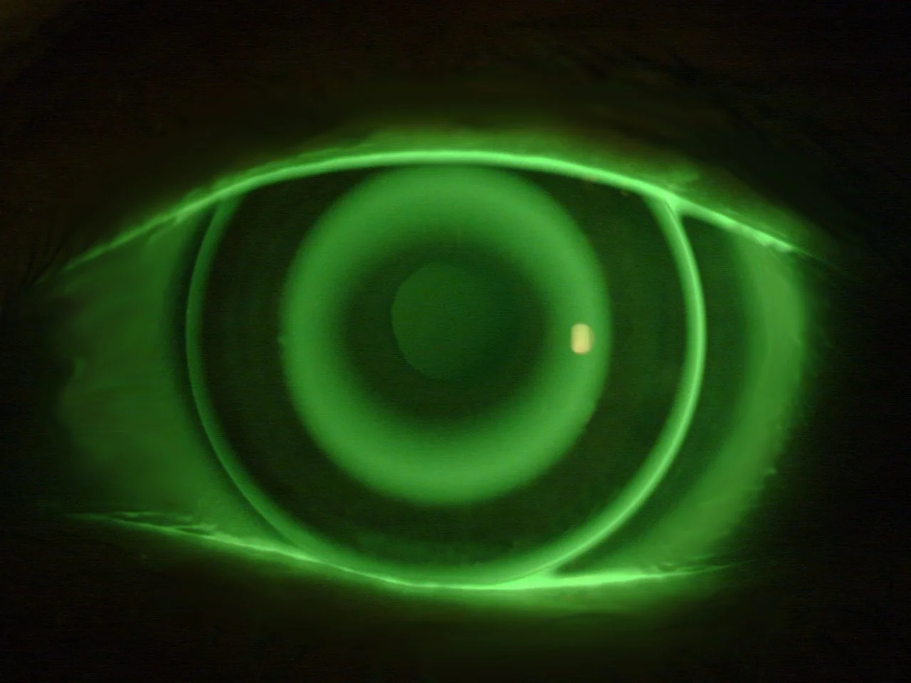 Ortokeratologi, Ortho-K, Drømmelinser, nattlinser i Stavanger Kontakt NyttSyn