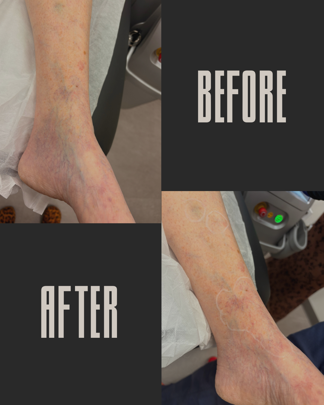 Close-up of an elderly person's leg and foot showing visible varicose veins and skin discoloration before treatment, and after treatment with some fading of veins and skin improvement.