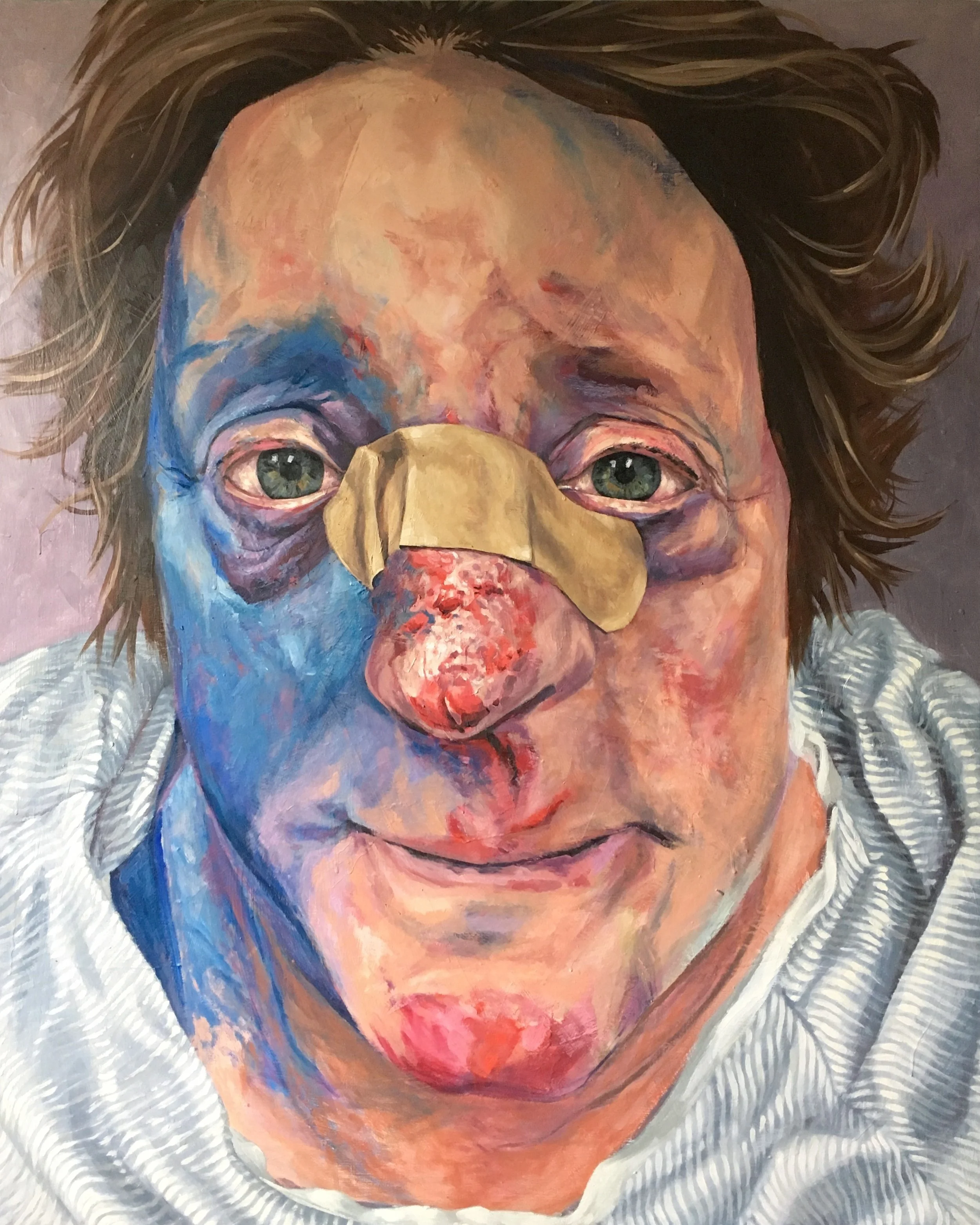 A portrait of a person with green eyes and tousled brown hair, wearing a beige nose bandage, with visible facial injuries, painted in a colorful, expressive style.
