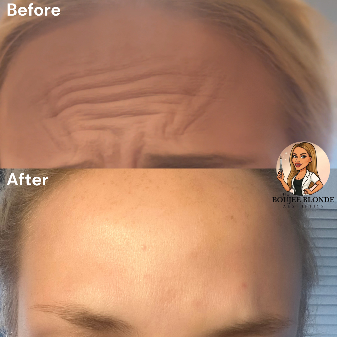 Comparison of a forehead's appearance before and after cosmetic treatment, showing deep wrinkles and smooth skin.