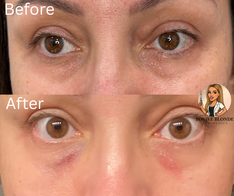 woman's eyes after PDGF under eye aesthetic treatment at  The top med spa in Slidell and aesthetics business for skin care