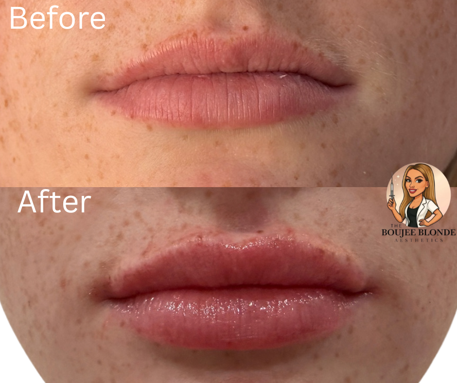 Before and after lip filler at The Boujee Blonde Aesthetics in Slidell, Louisiana showing natural volume enhancement, improved symmetry, and soft hydrated lips.