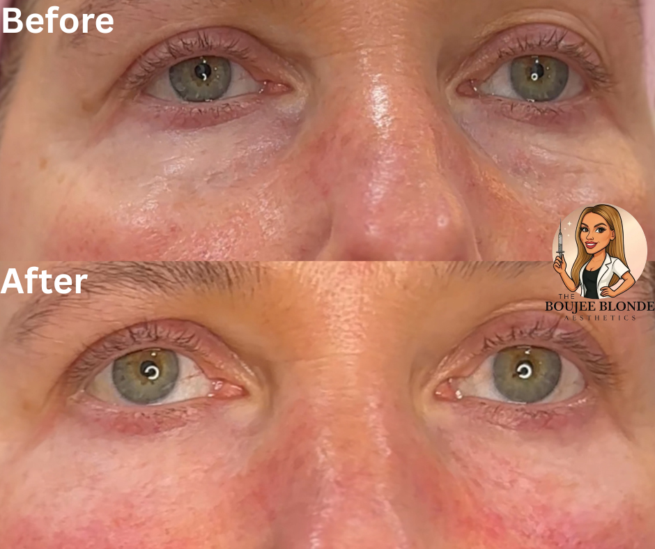 PDGF, plates derived growth factor, under eye treatment procedure performed by injector Marissa Hartman FNP-C at The Boujee Blonde Aesthetics in Slidell, Louisiana, a premier med spa and voted top med spa in Slidell