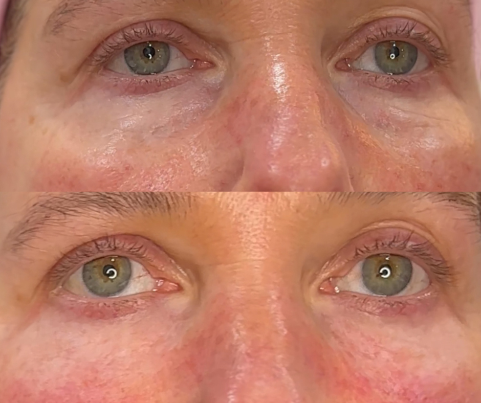 beforeandafter PDGF.png