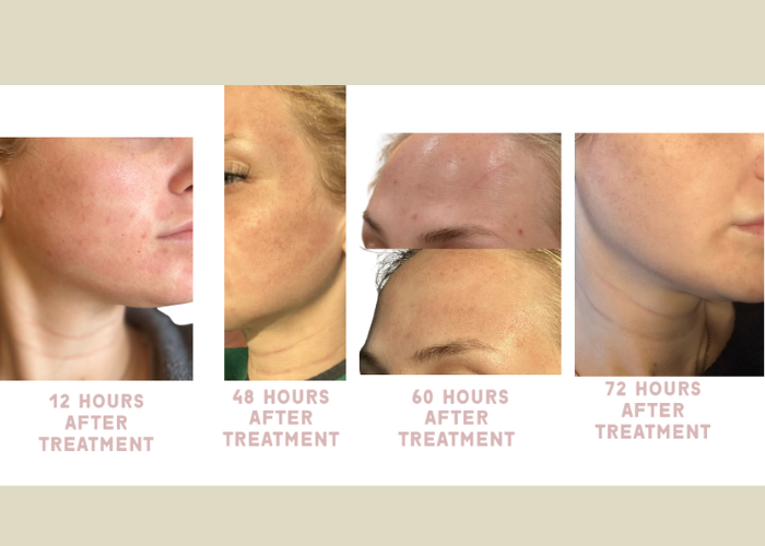 Progression of skin healing over time: 12, 48, 60, and 72 hours after treatment, showing improvement in skin condition.
