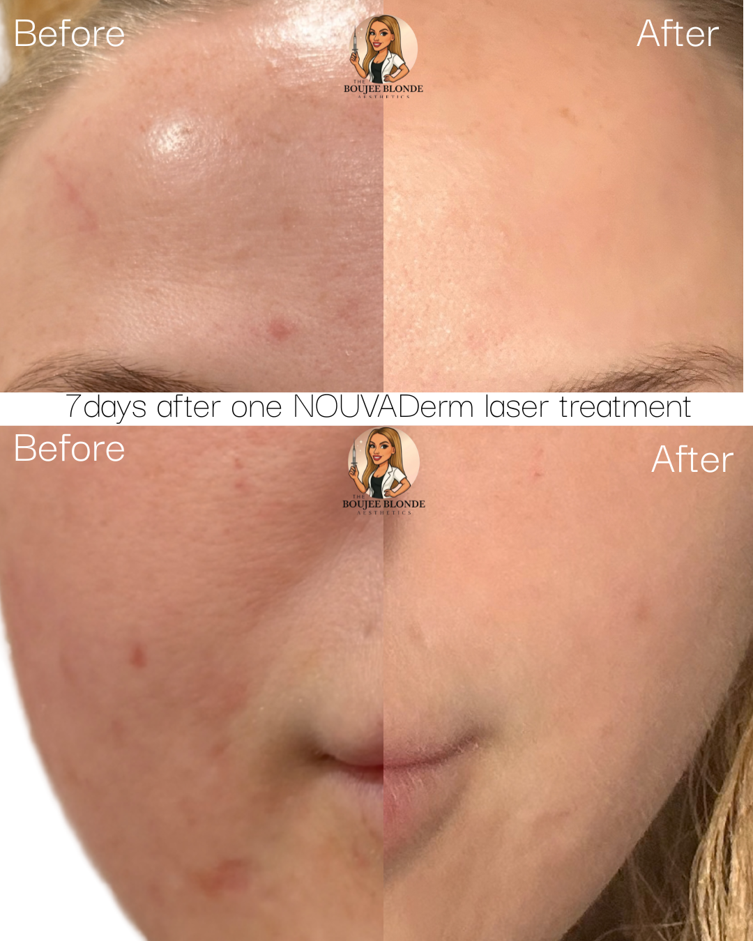 Comparison of a woman's face before and after one NOVADerm laser treatment, showing clearer skin, reduced blemishes, and smoother texture in the after images.