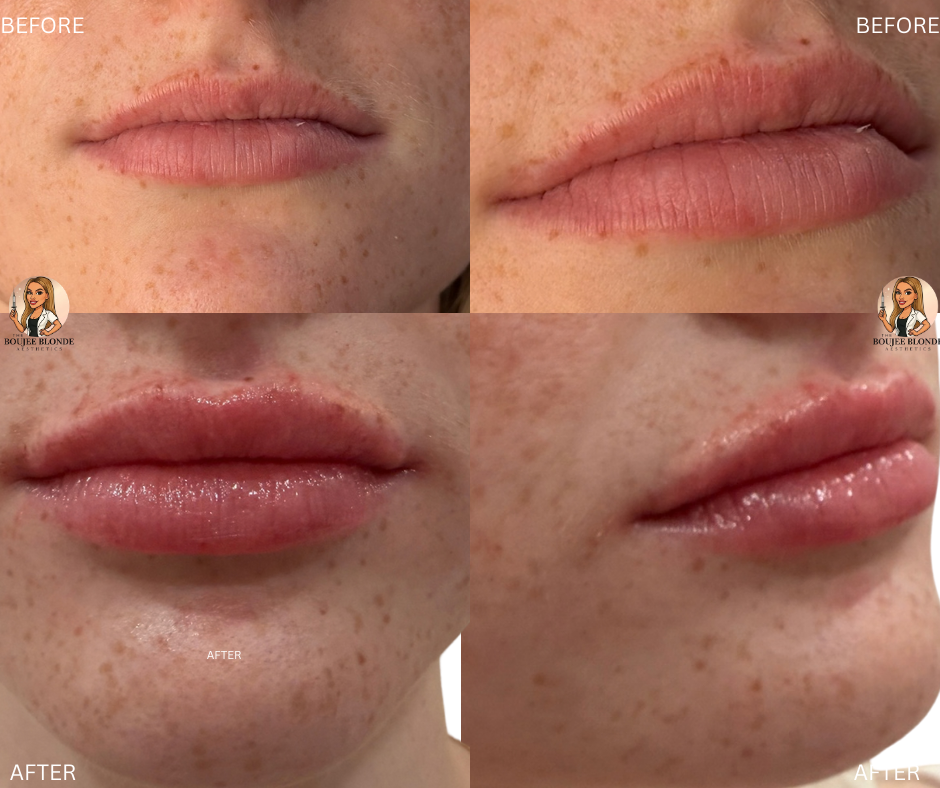 slidell medspa before and after lip filler enhancement 