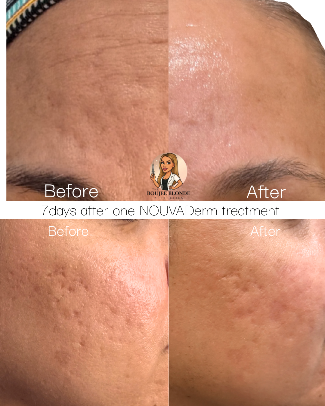 Comparison of skin before and after 7 days of one NOUVADerm treatment, showing improved skin texture and reduced hyperpigmentation.