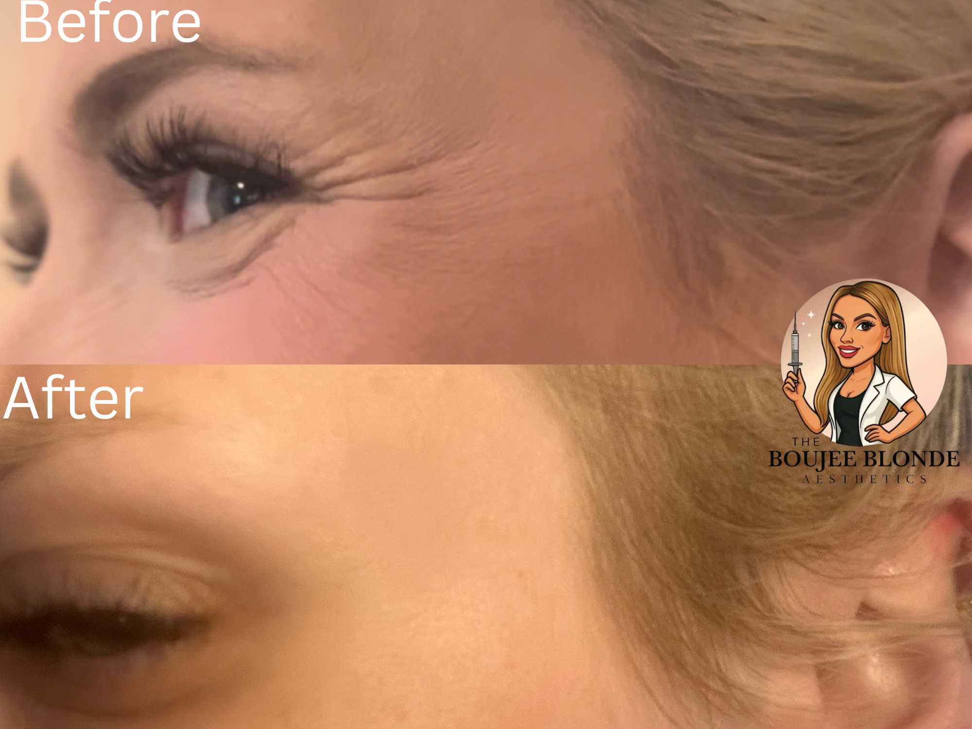 before and after botox- neurotoxins on patient at the Boujee Blonde Aesthetics med spa in Slidell, Louisiana