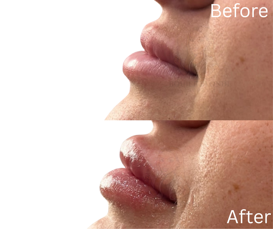 Close-up side view of lips and surrounding skin, showing before and after cosmetic lip enhancement, lip filler, slidell medspa